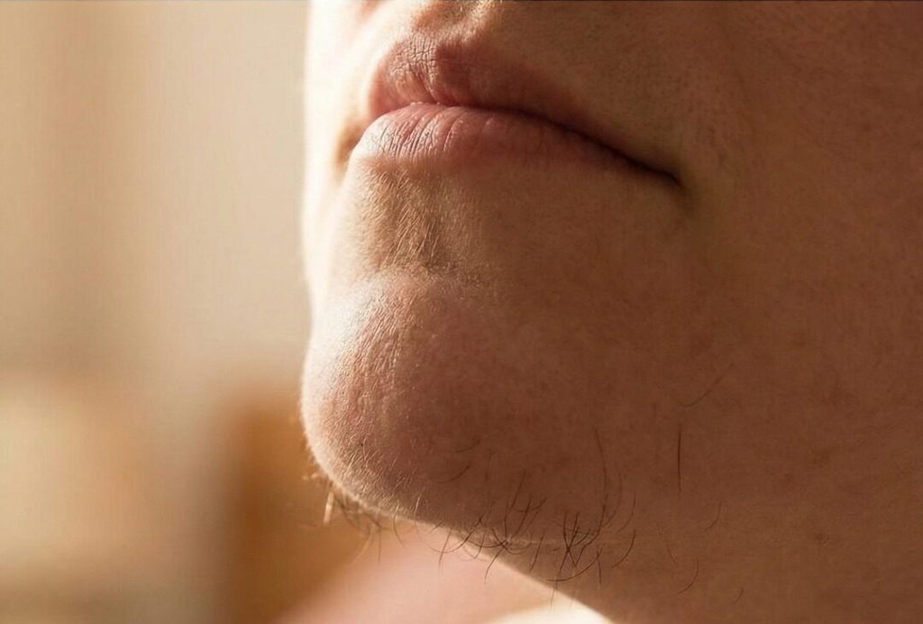 Chin Hair in Women: Why It Happens and How to Manage It Confidently